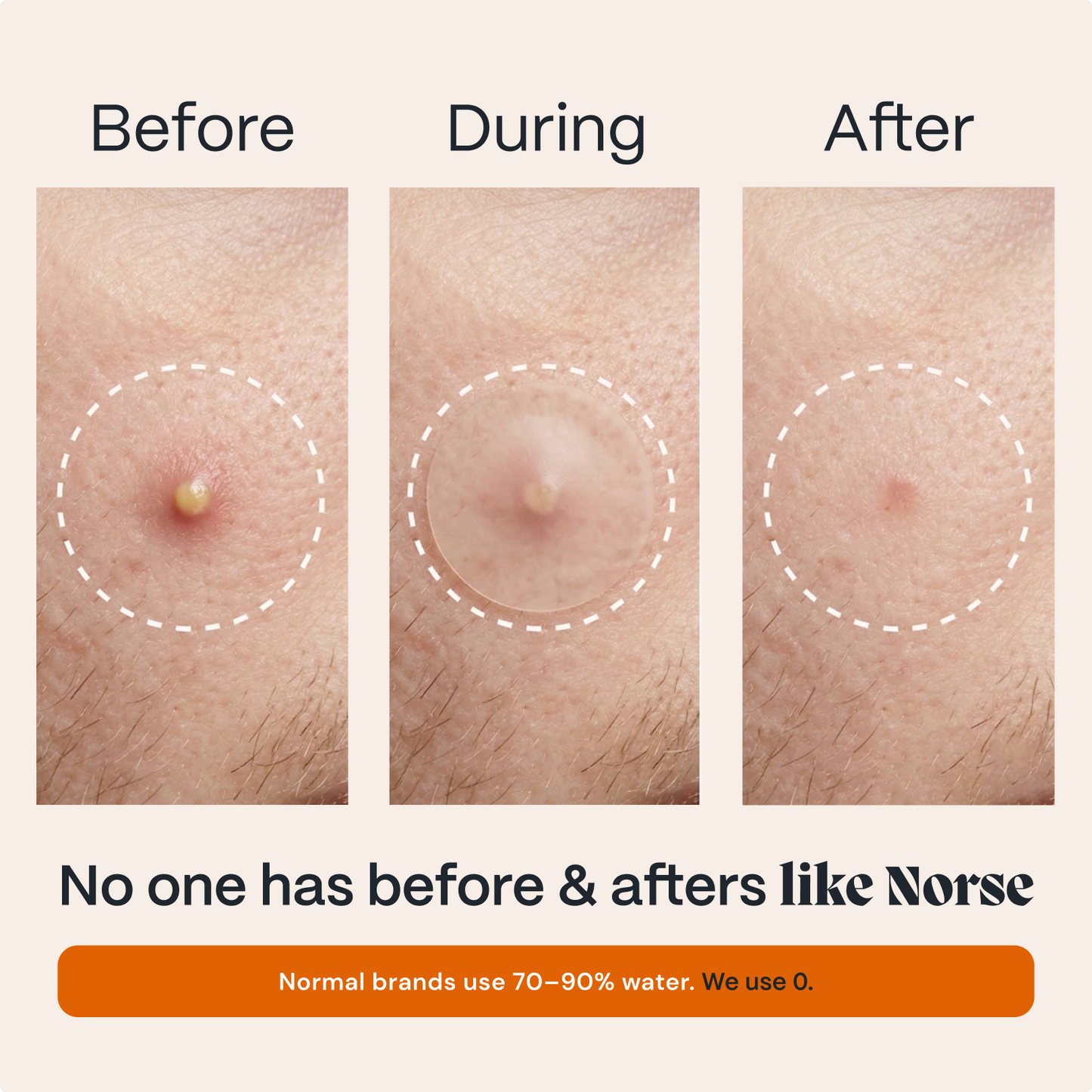 Before, during and after of a single pimple healing under a acne patch