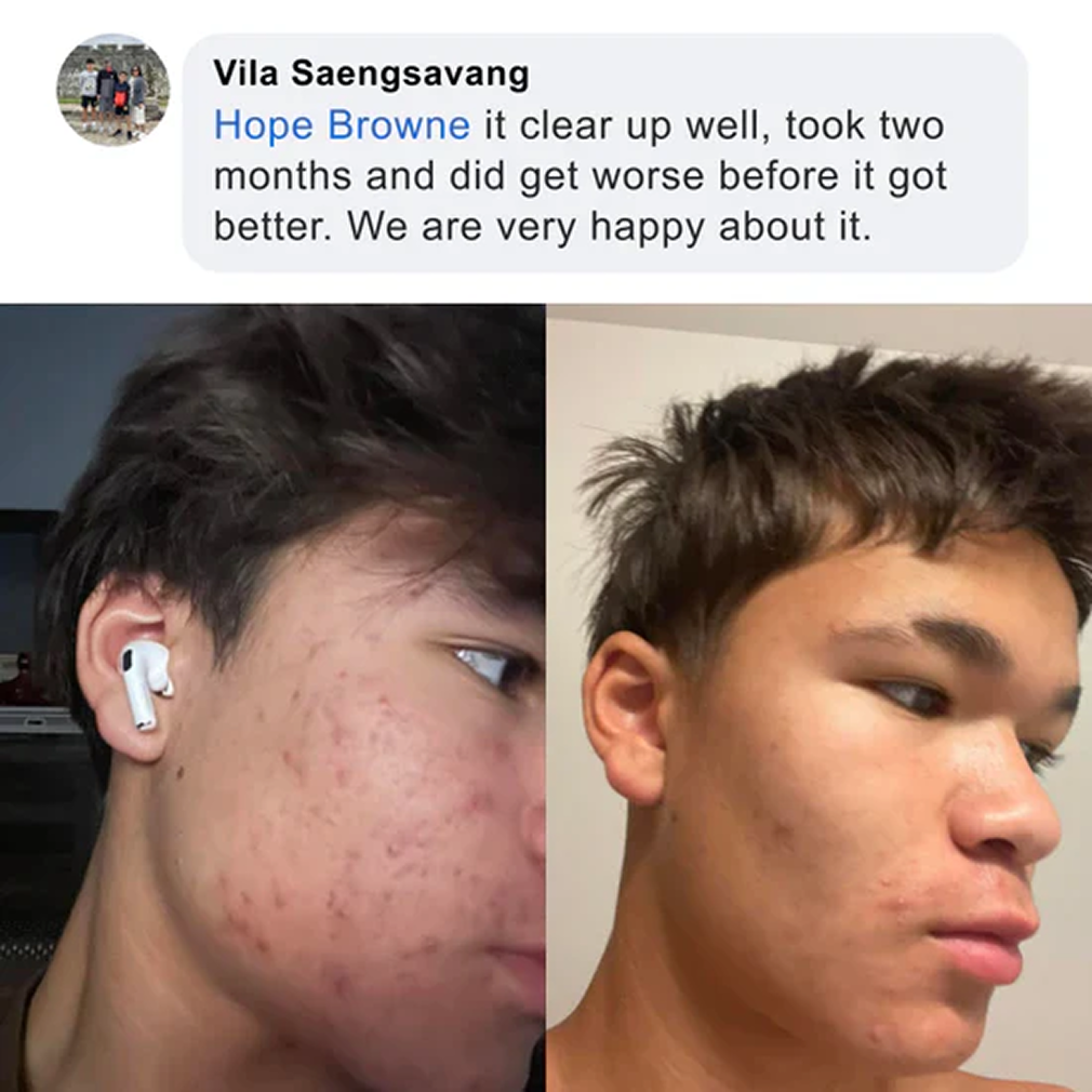 Before and after of a young man's face with a customer testimonial about Pimple Scars Balm 2.0