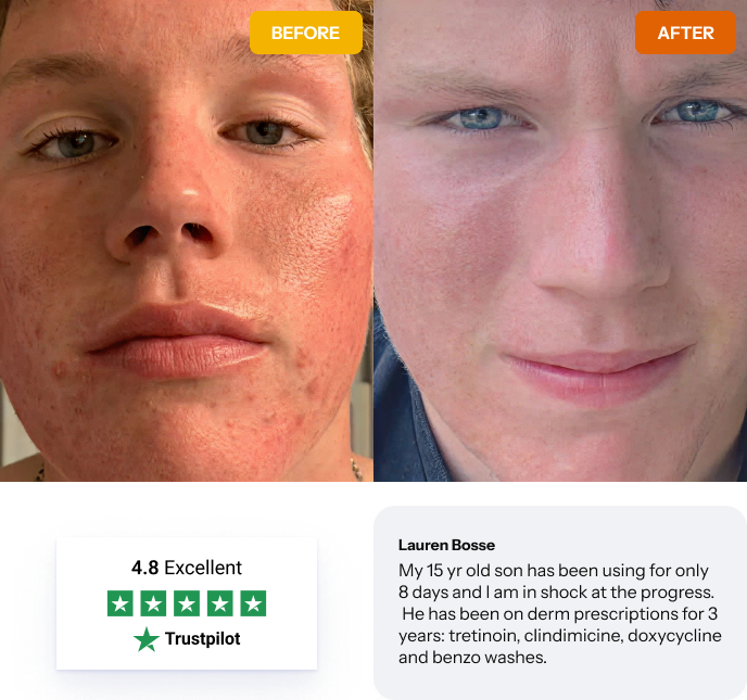 Acne Treatment Transformation