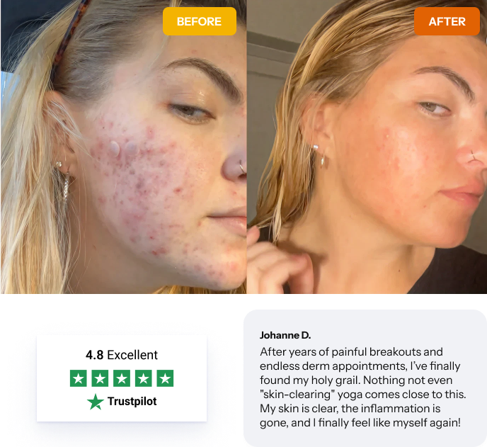 Natural Acne Treatment